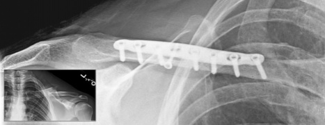 x-ray-superior-clavicle_3 80